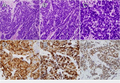 Histological And Immunohistochemical Findings Of The Breast Mass A