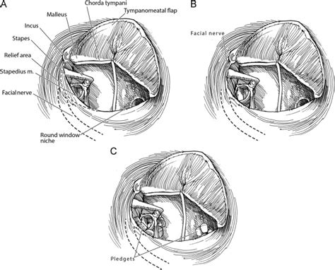 Exploratory Tympanotomy And Gentamicin Application In Patients With Intractable Meniere’s