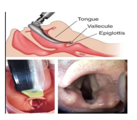 Endotracheal Intubation Flashcards Quizlet