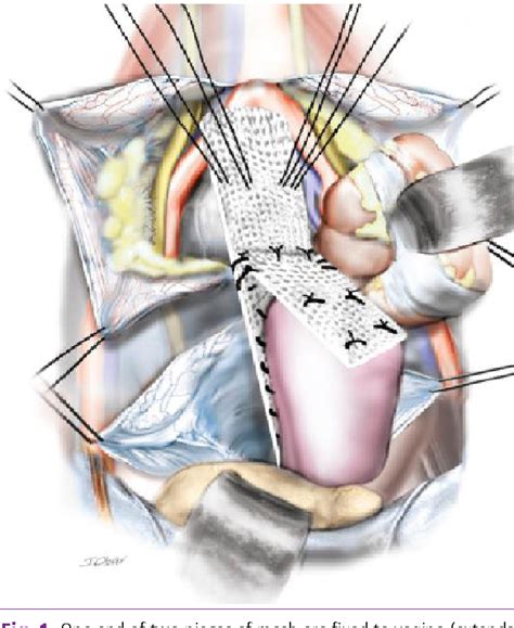 Figure 1 From Surgical Treatments For Vaginal Apical Prolapse