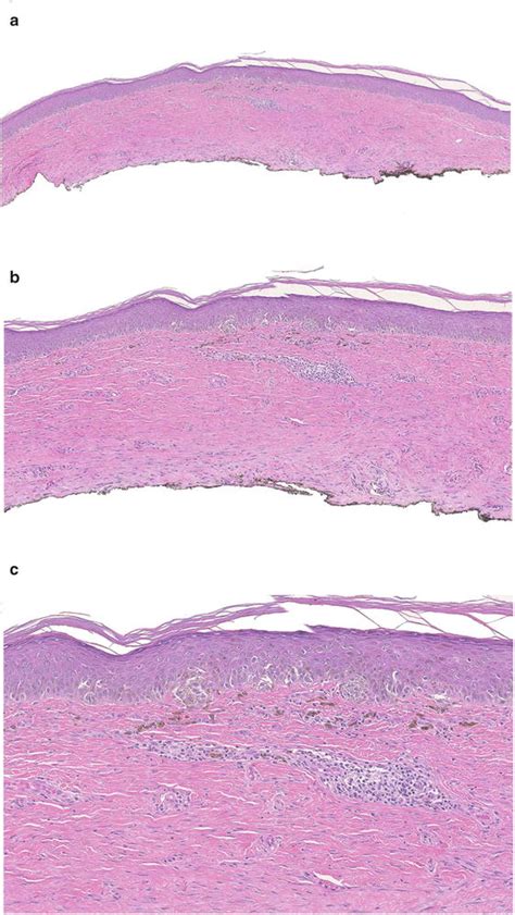 Dysplastic Nevi Basicmedical Key