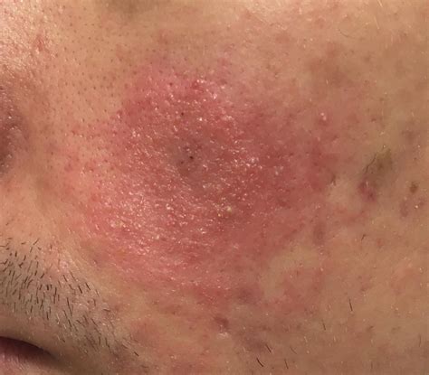 [acne] Benzoyl Peroxide Side Effects Or Allergy R Skincareaddiction