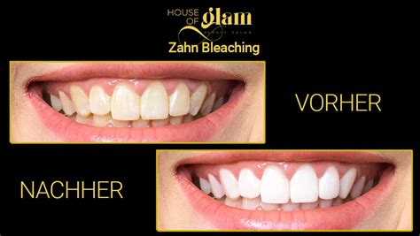 Zahnbleaching in Stuttgart | House of Glam