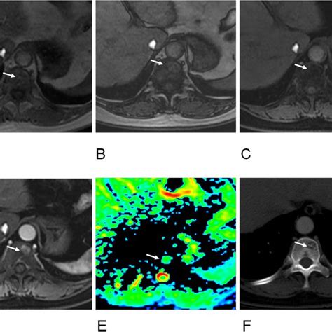 60 Year Old Women With Atypical Hemangioma Of T11 Vertebra A
