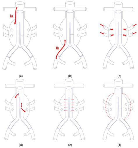 Embolization For Type Ia Endoleak After Evar For Abdominal Aortic