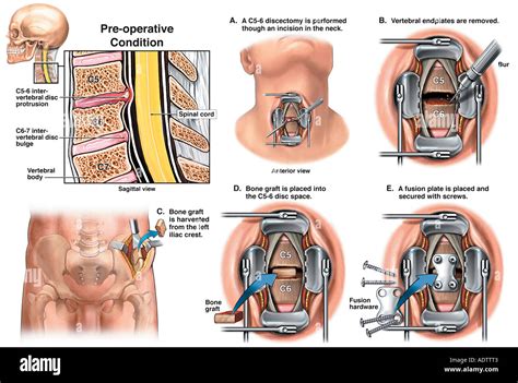 C5 6 And C6 7 Disc Herniations With Two Level Anterior 51 Off