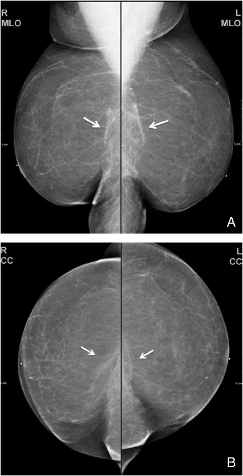 Review Of Breast Augmentation And Reconstruction For The Radiologist