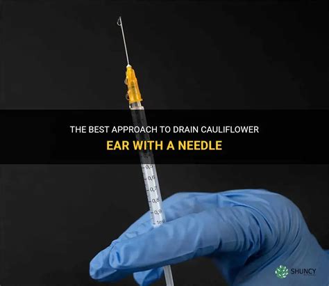 The Best Approach To Drain Cauliflower Ear With A Needle Shuncy