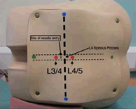 Lumbar Puncture Procedure - Position & Lumbar Puncture Side Effects