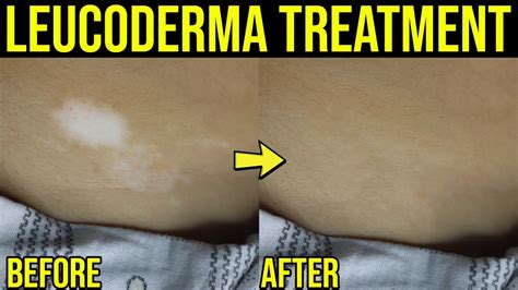 Treatment For Leucoderma Vitiligo Treatment Leucoderma Or White Spots Treatment Youtube