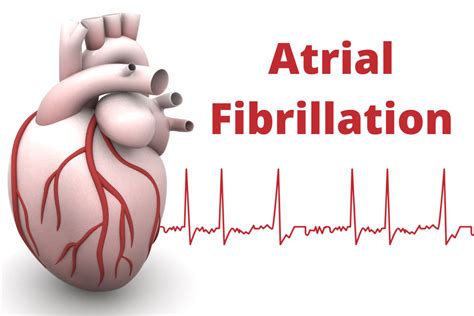 What Is AFib ENCORE Research Group