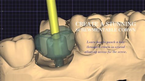 Ultimate Tutorial Screw Retained Implant Crown In Exocad Step By