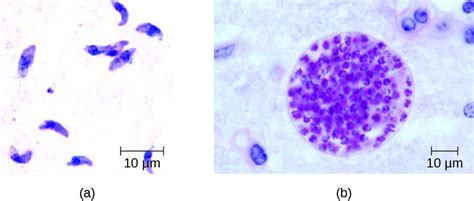 Plasmodium Falciparum Peritoneal Fluid