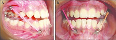 Application Of Class Iii Elastics Extending From The Infrazygomatic Download Scientific Diagram