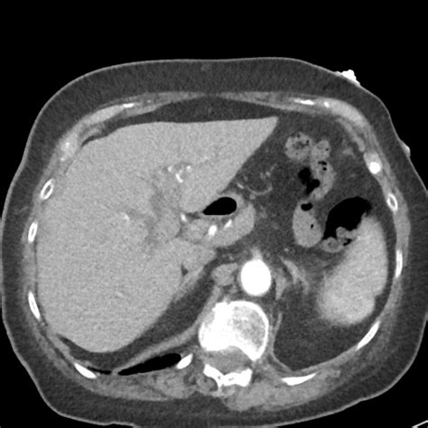 File Hiatus Hernia Containing Stomach Pancreas Splenic Flexure