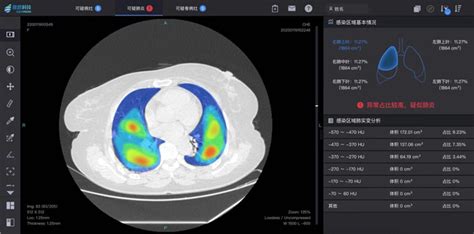 南开大学与推想科技利用ct影像ai筛查助力新冠肺炎疫情防控 南开要闻 南开大学