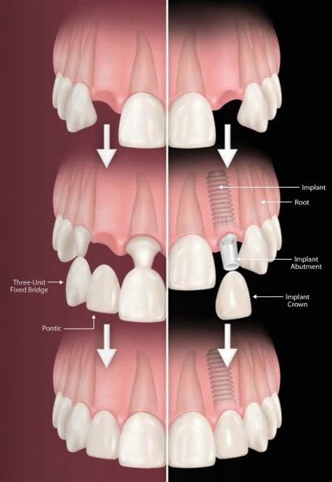 Dental Bridge Versus Dental Implant Dentist Pasadena Tx