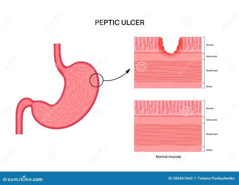 Peptic Ulcer Disease Vector Illustration 285667662