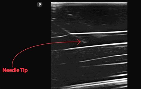 Ultrasound Guided Peripheral Iv Insertion Placement And Access Made Easy Pocus 101