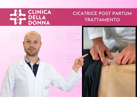 Cicatrice PostPartum Metodiche Di Trattamento Clinica Della Colonna