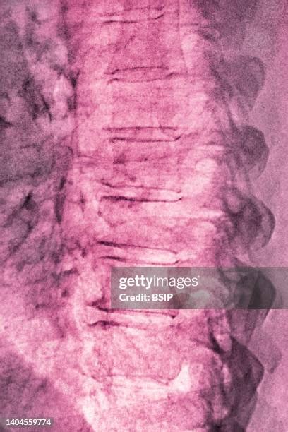 Degenerative Disc Disease Photos And Premium High Res Pictures Getty