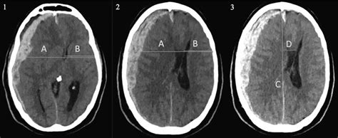 Midline shift brain causes, symptoms, diagnosis & treatment