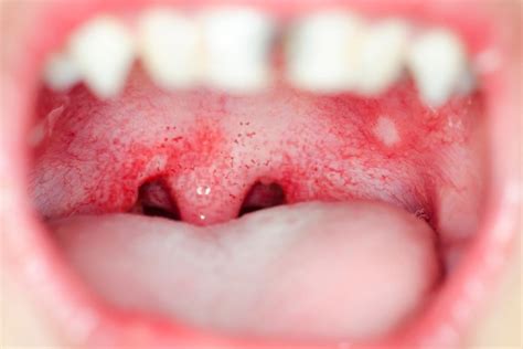 ¿por Qué Aparecen Puntitos Rojos Dentro De La Boca Blog Dental Irriak