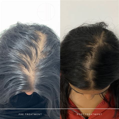 PRP Scalp — Entière Dermatology
