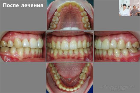 Брекеты до и после