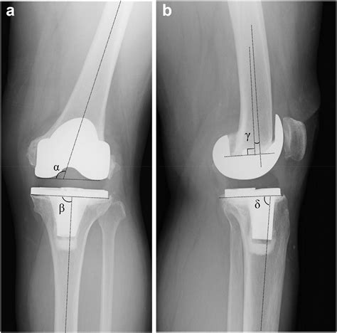 Anteroposterior A And Lateral B Plain Radiographs Before The Download Scientific Diagram