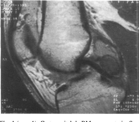 Figure 2 From Sinovitis Vellonodular Pigmentada Localizada De Rodilla