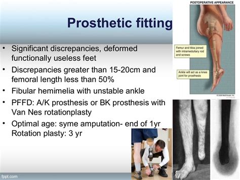 Limb Length Discrepency