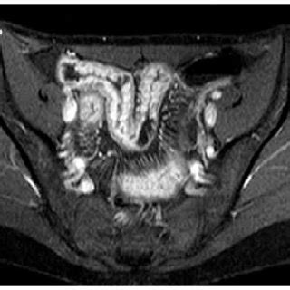 Examples Of Ileal Strictures A B Mr Enteroclysis Of An Ileal