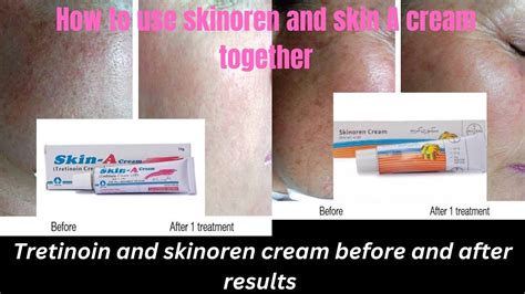 How To Use Skinoren Cream And Skin A Cream Together Before And After