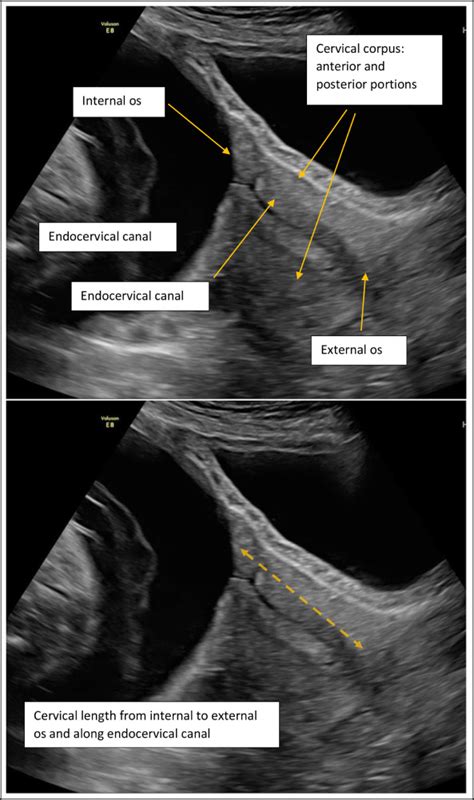 Guideline No 401 Sonographic Cervical Length In Singleton Pregnancies Techniques And Clinical