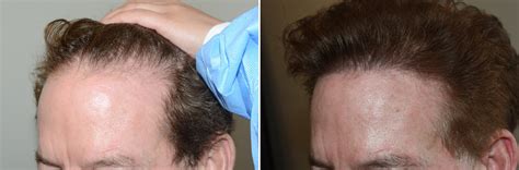 Hair Transplants For Men Photos Miami Fl Patient127013