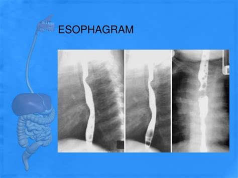 Esophageal Varices X Ray