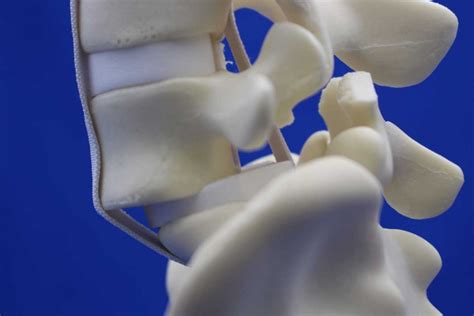 SSS With Spondylolisthesis L5S1