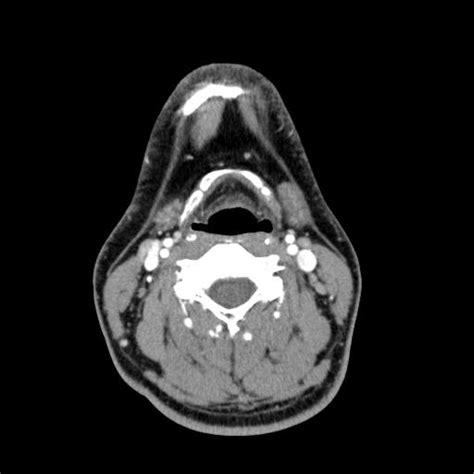 Submandibular Gland Main Duct Sialolith Image Radiopaedia Org