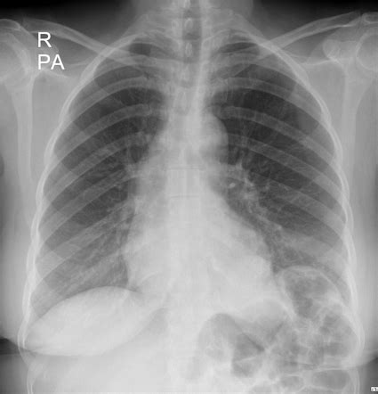 Pulmonary Sequestration Radiology Reference Article Radiopaedia Org