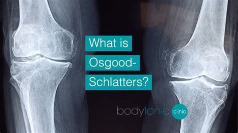 Osgood Schlatter Disease Symptoms