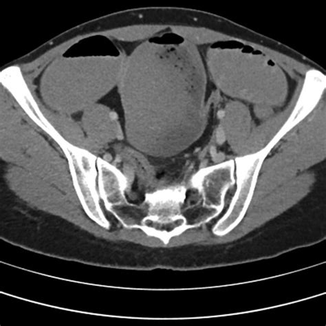 Computed Tomography Scan Of The Abdomen Showing Small Bowel Obstruction