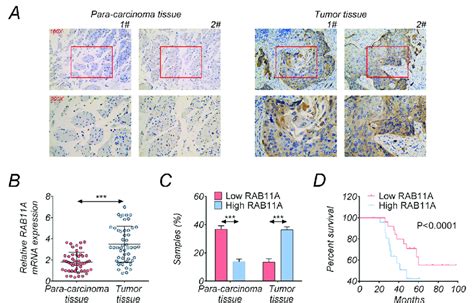 RAB11A Was Upregulated In Human EC Tissues And Predicted Poor