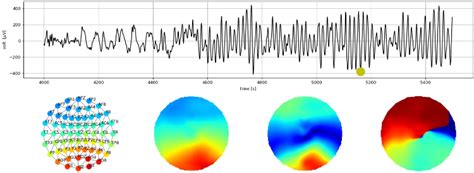 Resting State Eeg Patterns Gds Projects