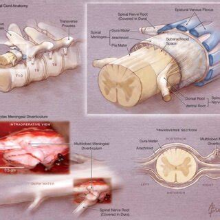 Spinal Cord Anatomy And Intraoperative Photograph With Corresponding