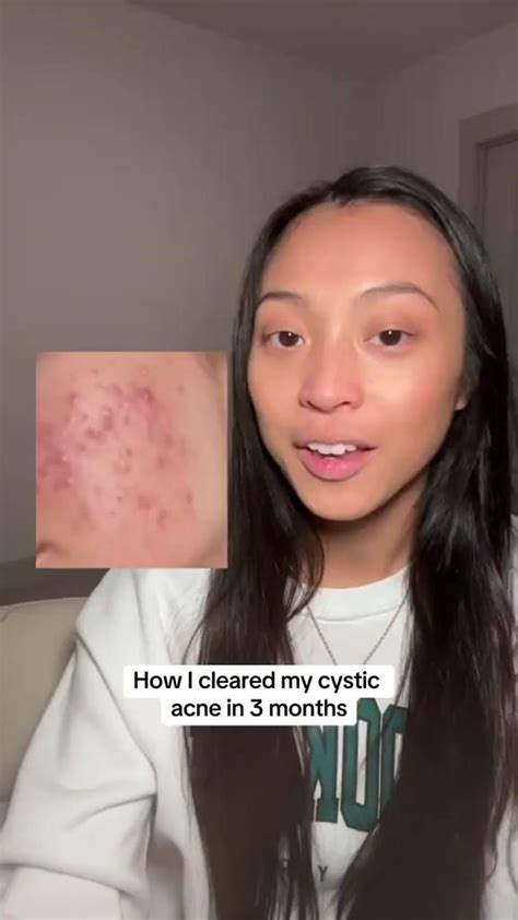 How I Cleared My Cystic And Hormonal Acne From Having It Since Middle