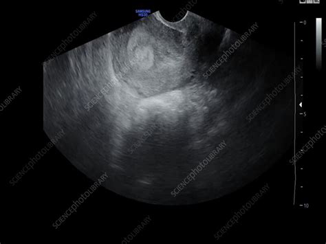 5 Week Old Embryo Transvaginal Ultrasound Scan Stock Video Clip