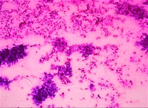 Metastatic Squamous Cell Carcinoma To Lymph Node Highly Cellular Smear Download Scientific