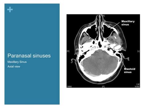 Nasal Cavity And Paranasal Sinuses Radiologic Anatomy Ppt Free Download