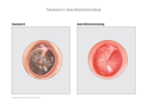 Mittelohrentzündung bei Kindern und Erwachsenen HNO Praxis Sarnen